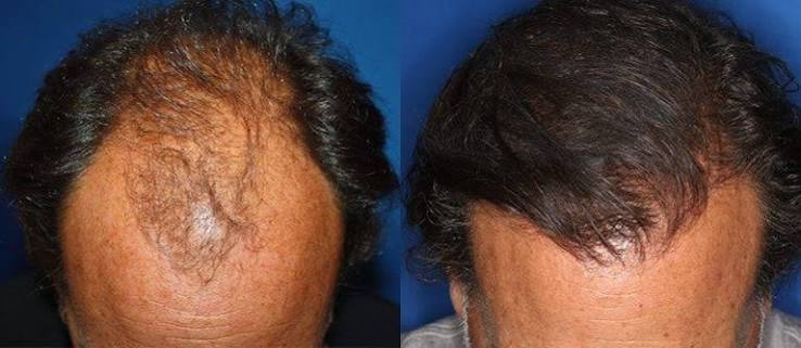 Hybrid Hair Transplant
